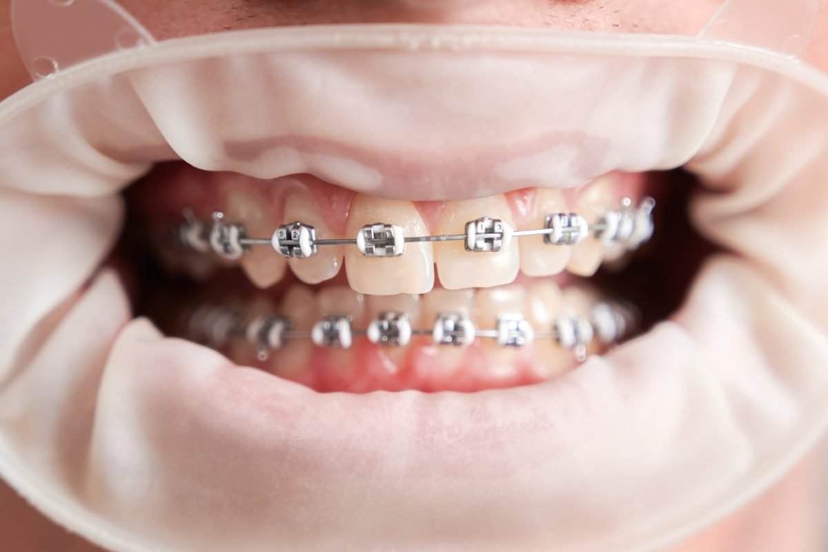 Male patient with cofferdam in mouth showing teeth with braces. Close up of young man demonstrating teeth with wired metal braces. Healthy straight teeth with orthodontic braces and white cofferdam. Concept of dentistry, stomatology and orthodontic treatment.